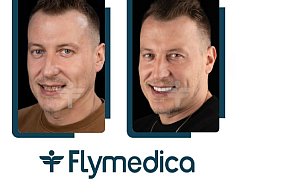 Estetyka uśmiechu a pojęcie „Hollywood smile” – co warto wiedzieć?-44573